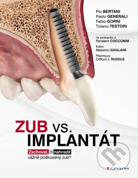Kniha: Zub vs. implantát (Pio Bertani, Paolo Generali, Fabio Gorni a Tiziano Testori). Grada, 2025 Kniha: Zub vs. implantát (Pio Bertani, Paolo Generali, Fabio Gorni a Tiziano Testori). Grada, 2025