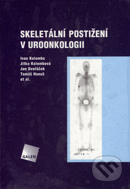 Kniha: Skeletální postižení v uroonkologii (Ivan Kolombo, Jan Dvořáček, Jitka Kolombová a Tomáš Hanuš). Galén, 2005 Kniha: Skeletální postižení v uroonkologii (Ivan Kolombo, Jan Dvořáček, Jitka Kolombová a Tomáš Hanuš). Galén, 2005