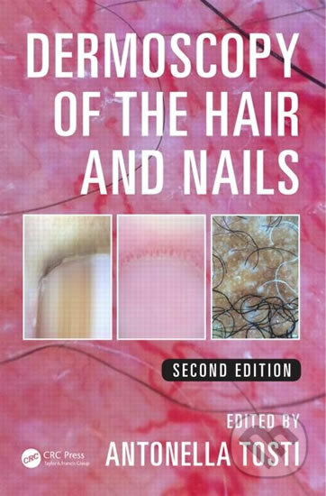 Kniha: Dermoscopy of the Hair and Nails 2nd Edition (Antonella Tosti). Taylor & Francis Books, 2015 Kniha: Dermoscopy of the Hair and Nails 2nd Edition (Antonella Tosti). Taylor & Francis Books, 2015