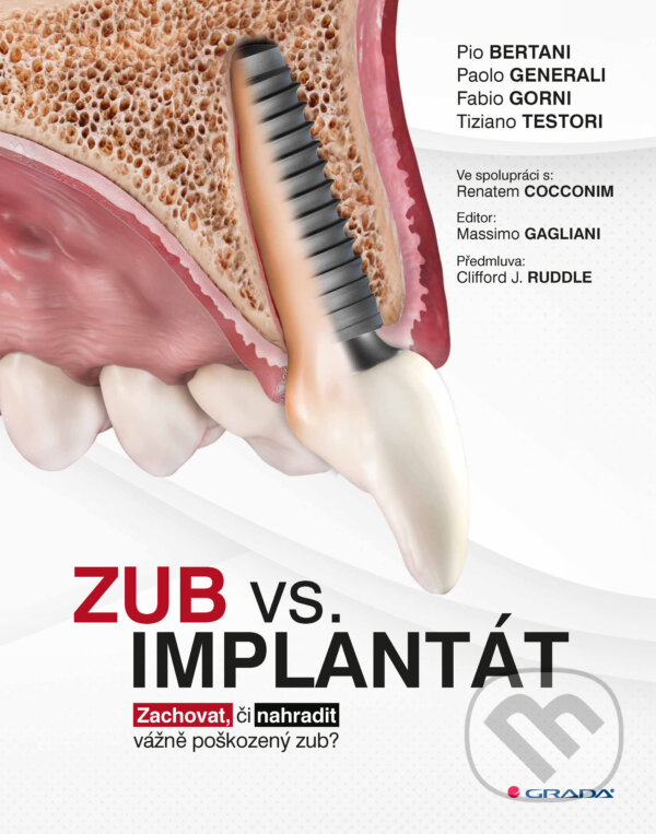 E-kniha: Zub vs. implantát (Pio Bertani, Paolo Generali, Fabio Gorni, Testori Tiziano a kolektív). Grada, 2025 E-kniha: Zub vs. implantát (Pio Bertani, Paolo Generali, Fabio Gorni, Testori Tiziano a kolektív). Grada, 2025