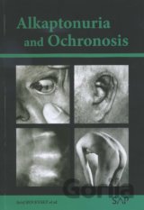 Alkaptonuria and ochronosi