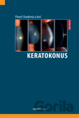 Keratokonus
